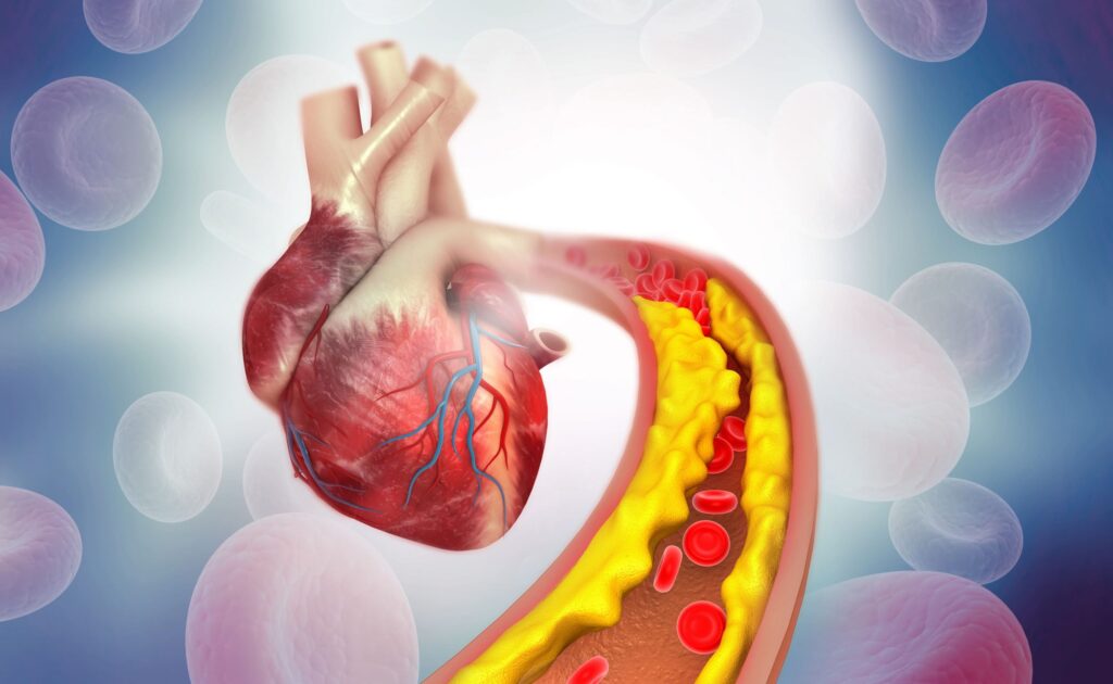 Global Atherosclerosis Market