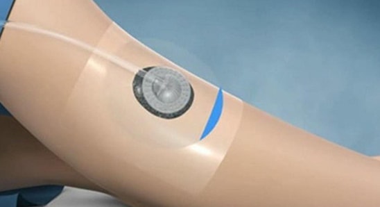 Global Disposable Negative Pressure Wound Therapy Devices Industry
