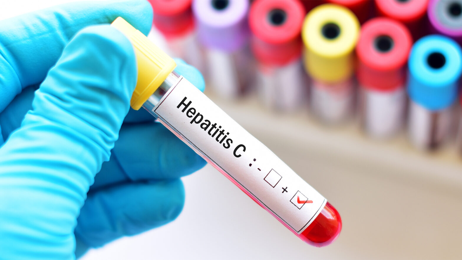 Global Hepatitis C Virus (HCV) Testing Industry