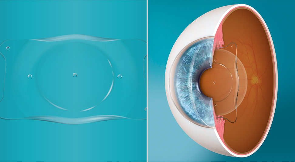 Global Implantable Collamer Lens Industry