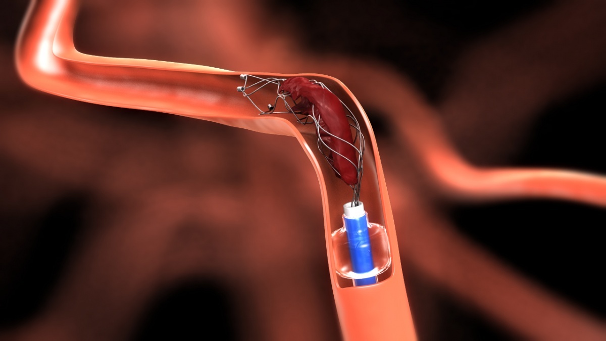 Global Neurovascular Devices Interventional Neurology Industry