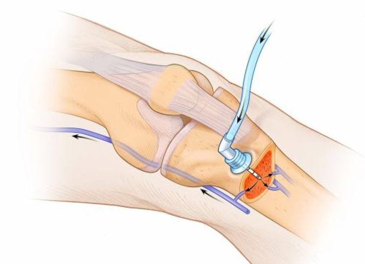 Intraosseous Infusion Devices Industry