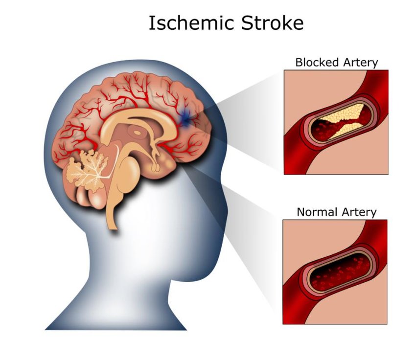 Ischemic Stroke Aspiration Systems Industry