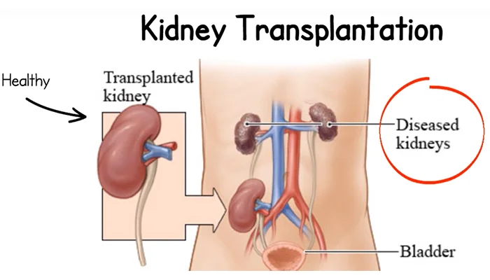 Kidney Transplant Industry