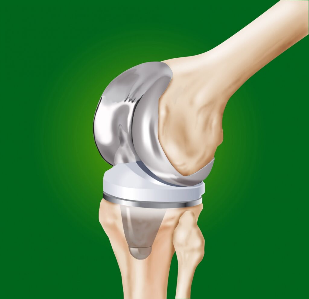 Knee Reconstruction Devices Market