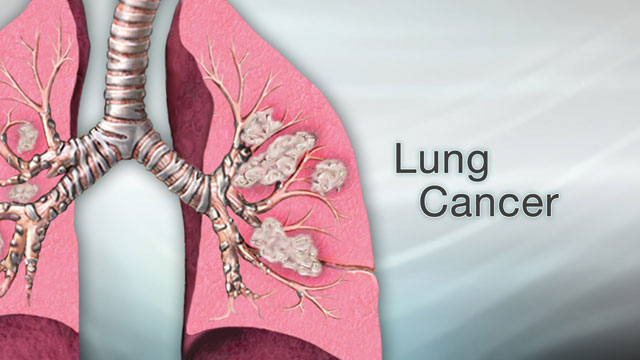 Lung Cancer PCR Panel Industry