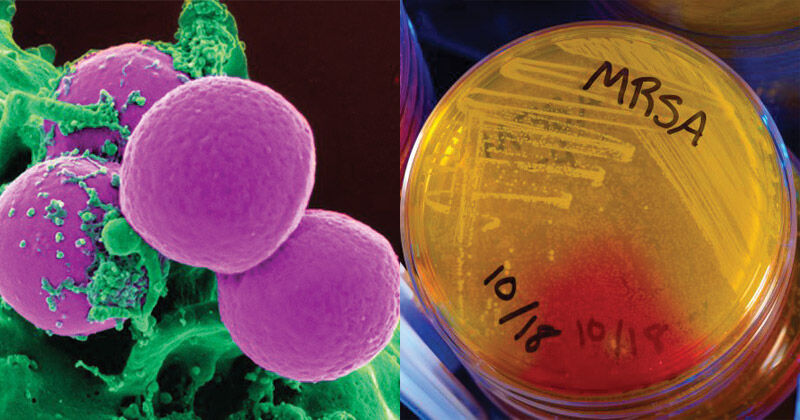 Methicillin-Resistant Staphylococcus Aureus (MRSA) Treatment Industry