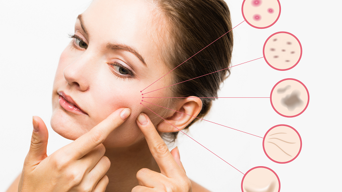 Moderate-to-Severe Acne Treatment Industry