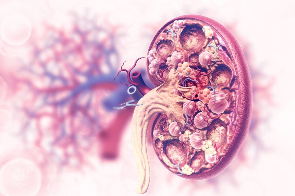 Nephroblastoma Treatment Industry