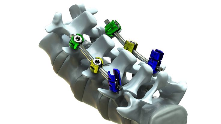 Pedicle Screw Systems Market