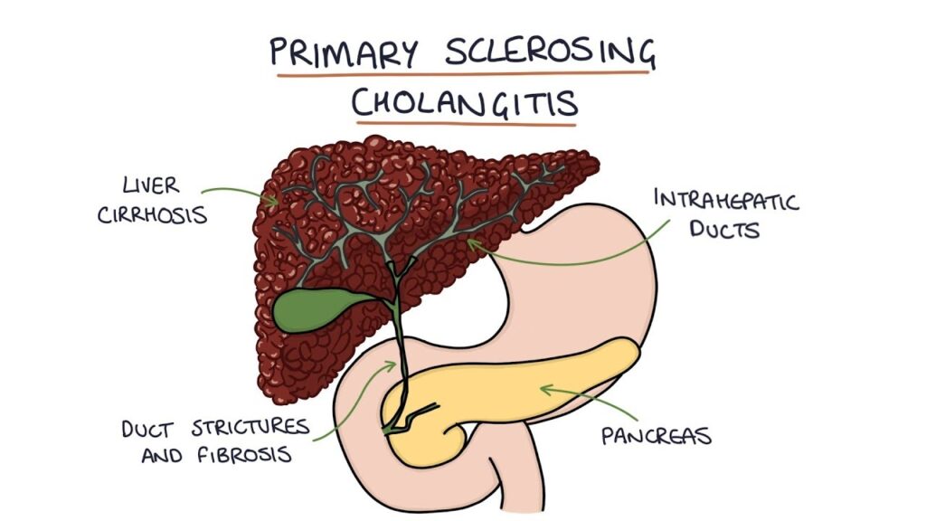 Primary Sclerosing Cholangitis (PSC) Industry