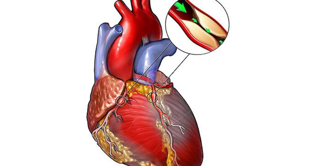 Prinzmetal Angina Therapeutics Industry