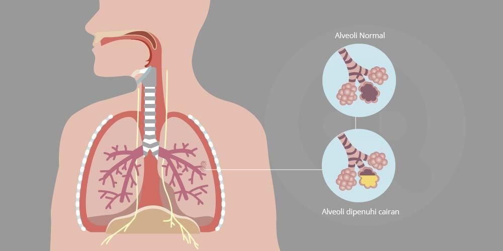 Respiratory Distress Syndrome Management Industry