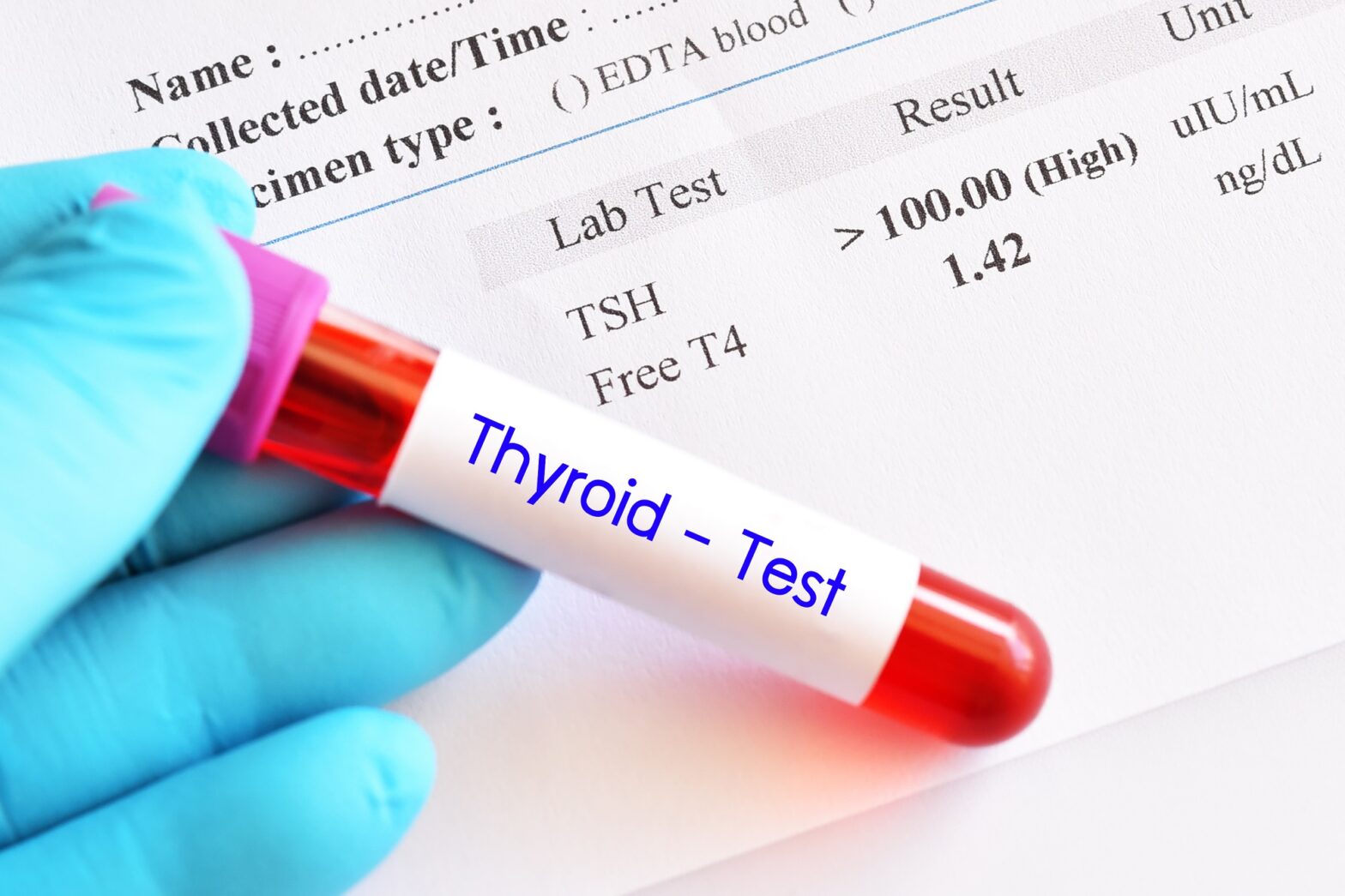 Global Thyroid Function Test Industry