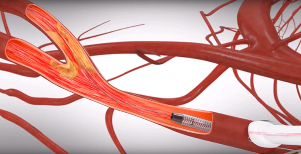 Venous Stents Industry