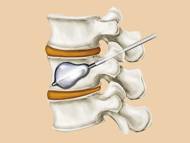 Vertebral Augmentation Devices Market