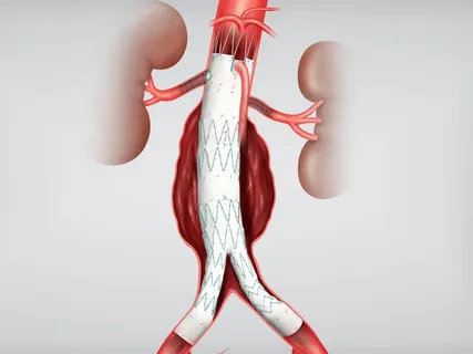 Aortic Stents Grafts Propel Market