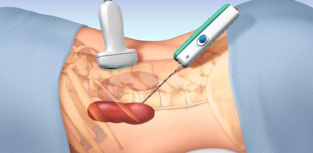 Aspiration & Biopsy Needle Market