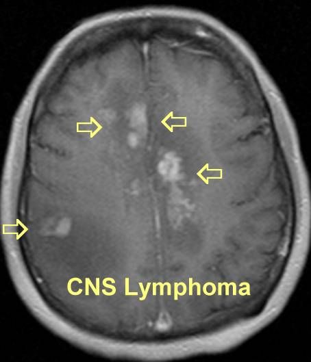 Central Nervous System Lymphoma Treatment Market