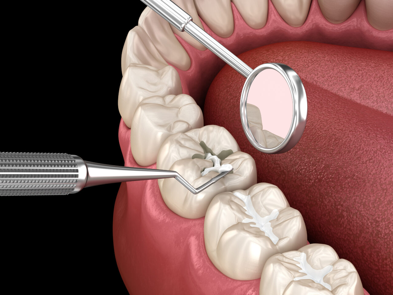 Global Dental Sealants Industry