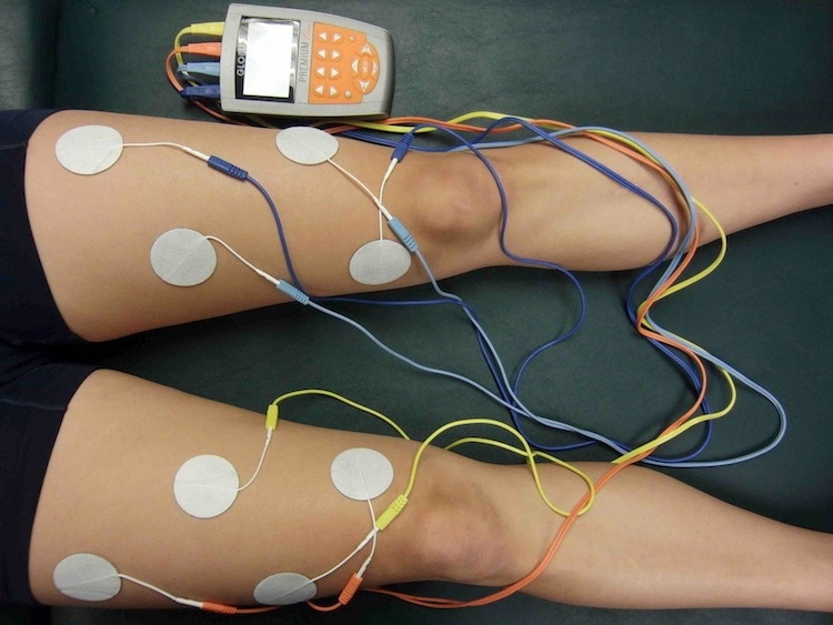 Global Functional Electrical Stimulation Industry