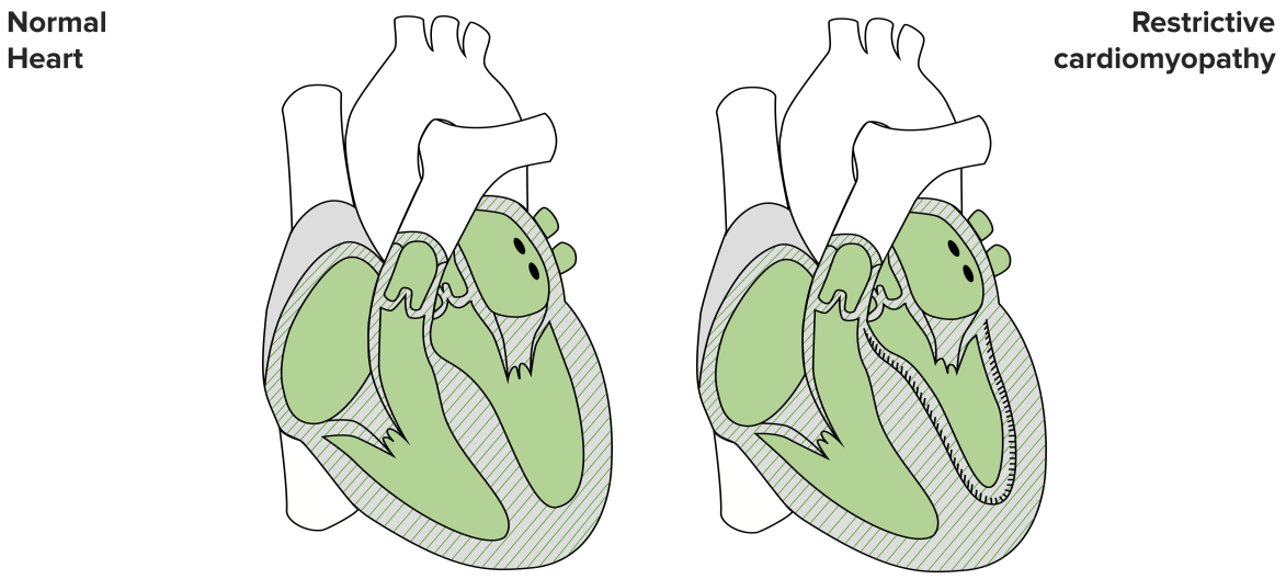 Global Restrictive Cardiomyopathy Treatment Industry