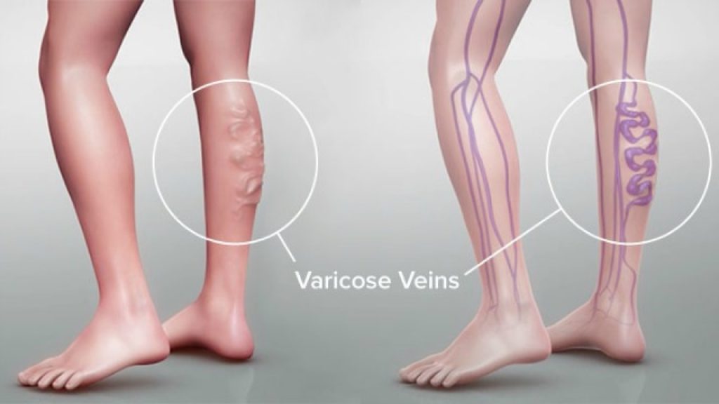 Global Varicose Vein Treatment Industry