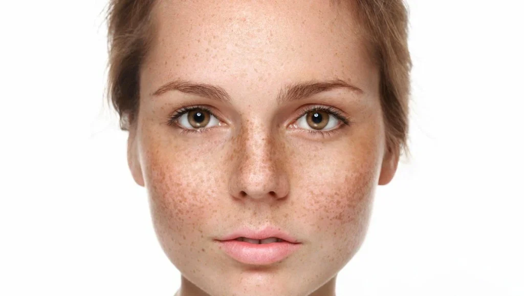 Hyperpigmentation Treatment Market