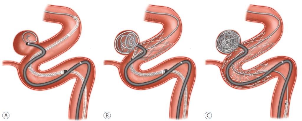 Intracranial Aneurysm Market