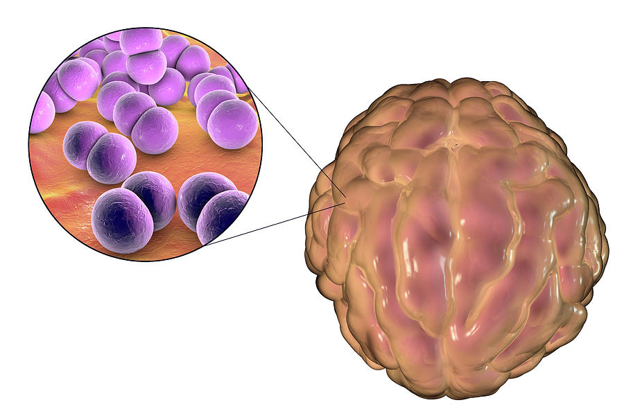 Global Meningococcal Meningitis Treatment Industry