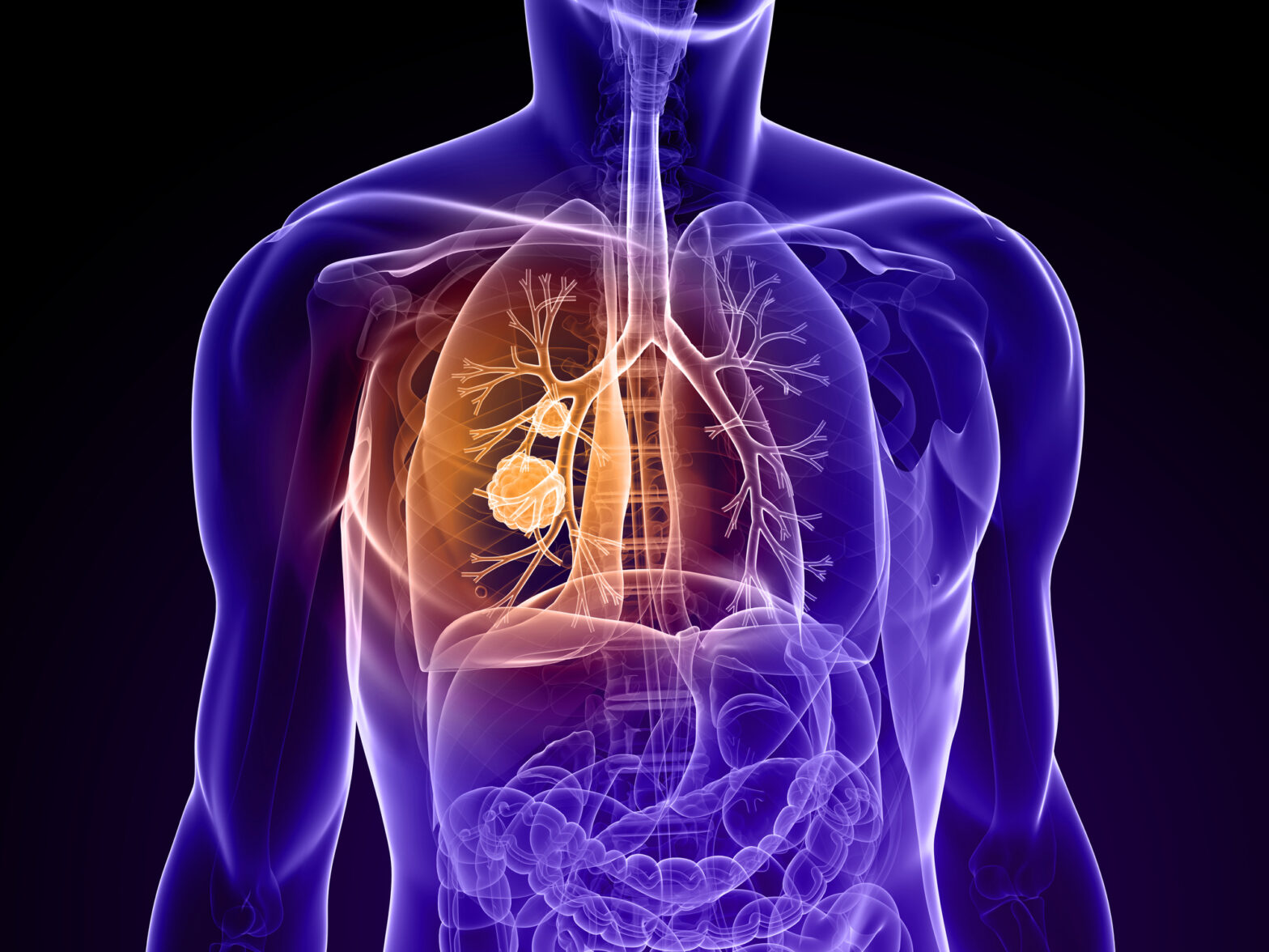 Global Pleural Diseases Therapeutics Market