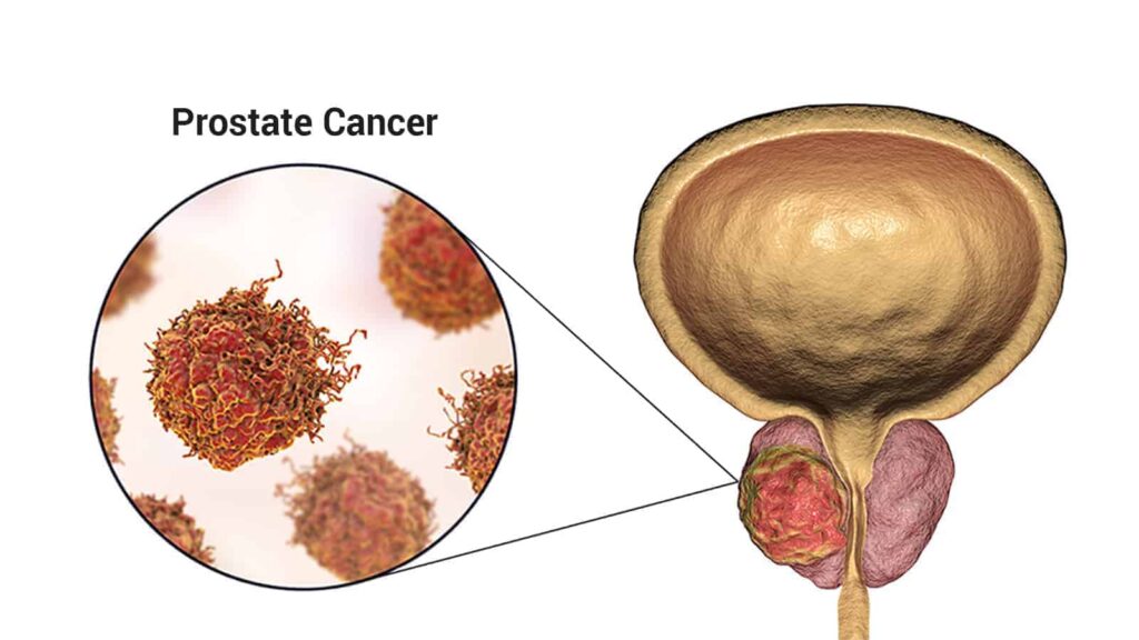 Prostate Cancer Market