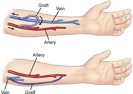 Arteriovenous Fistula Treatment Market