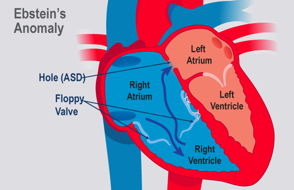 Ebstein's Anomaly Market