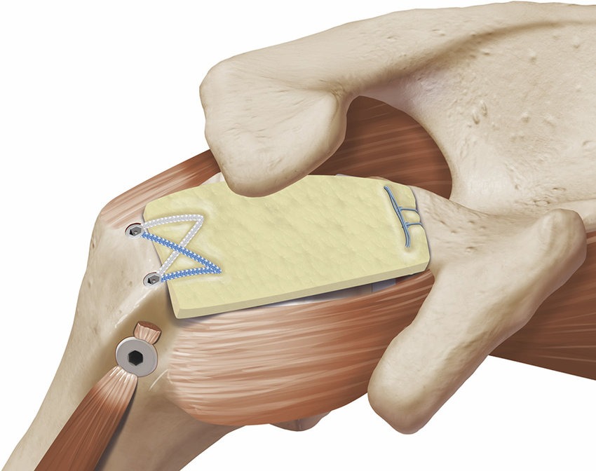 Bone Graft Fixation System Market