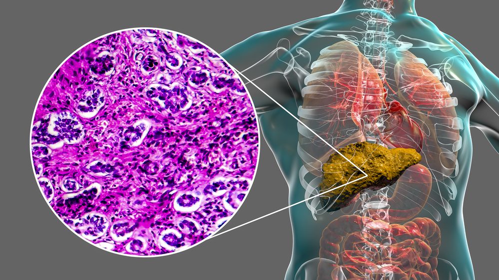 Cirrhosis Management Market