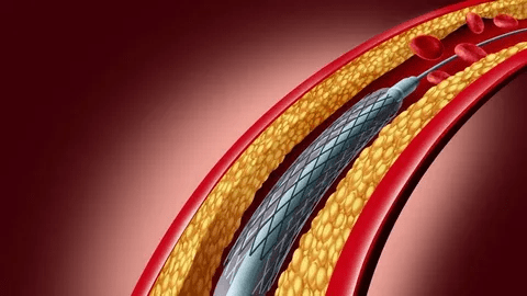 Coronary Stent Market