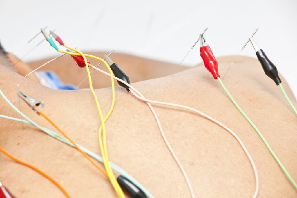 Electric Acupuncture Devices Market