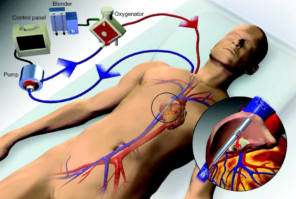 Extracorporeal Membrane Oxygenation Machine Market