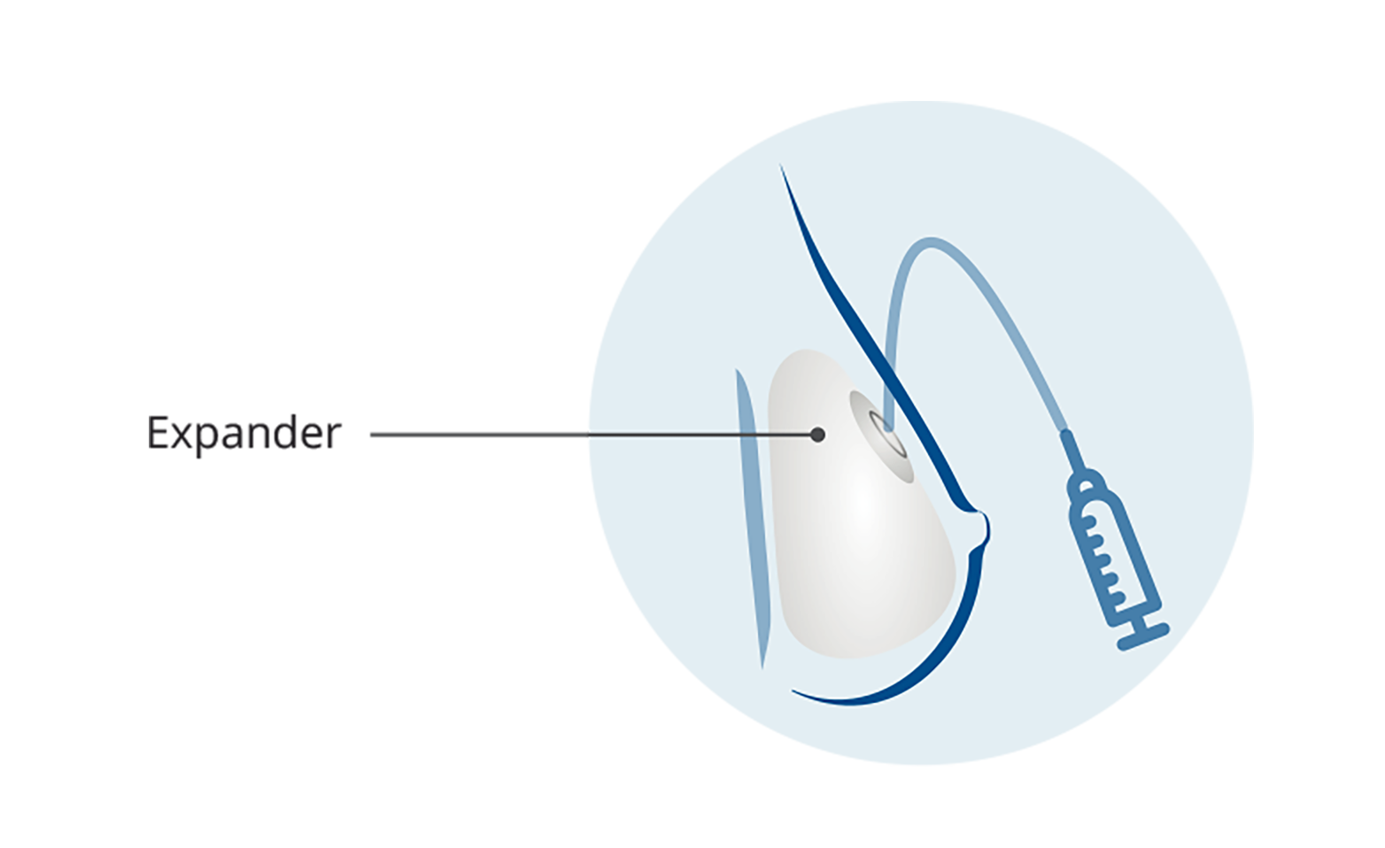 Global Extremity Tissue Expanders Industry