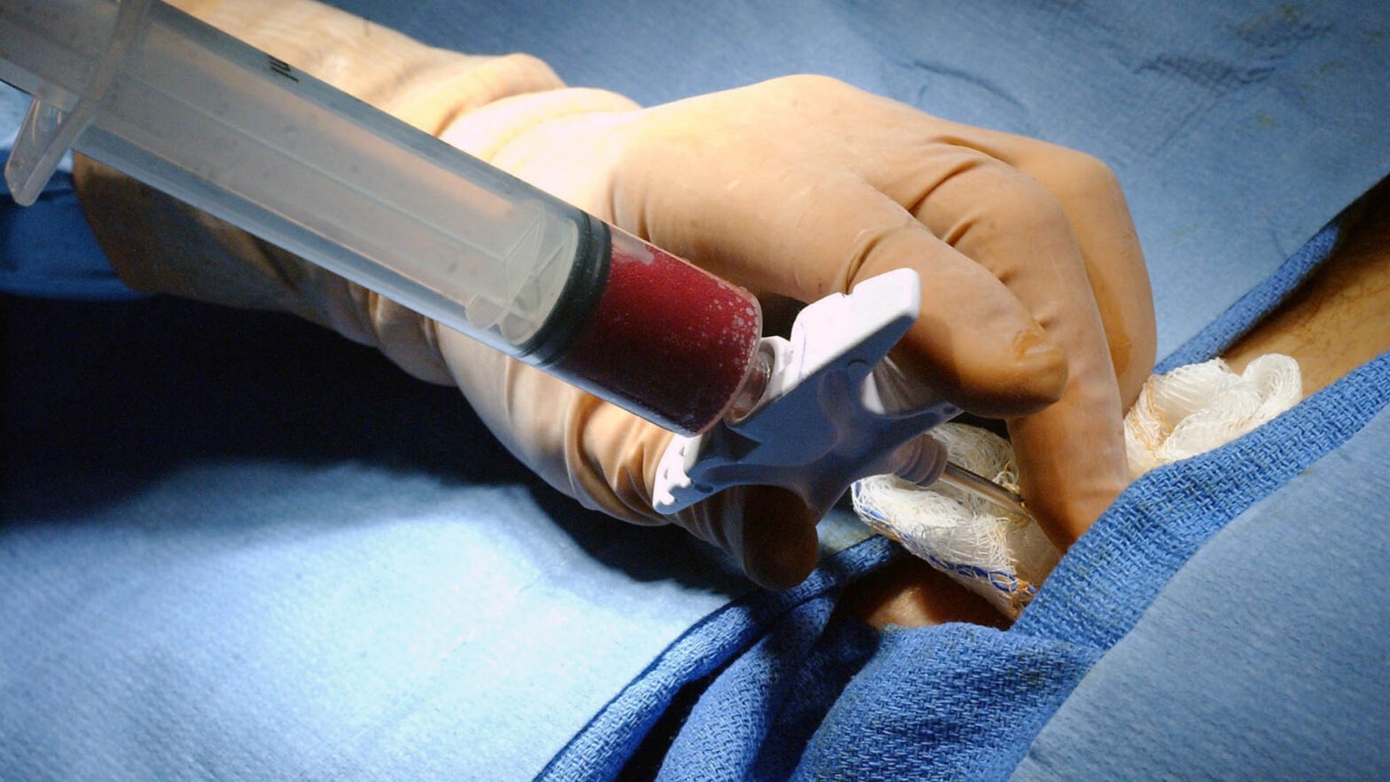 Global Bone Marrow Transplant Industry