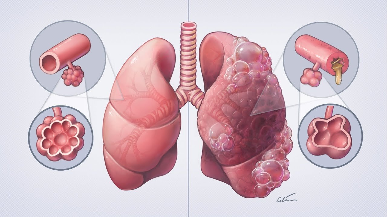 Global Chronic Obstructive Pulmonary Disease Industry