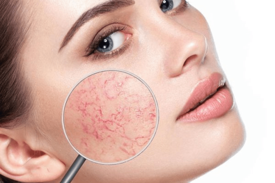 Global Facial Erythema Treatment Market