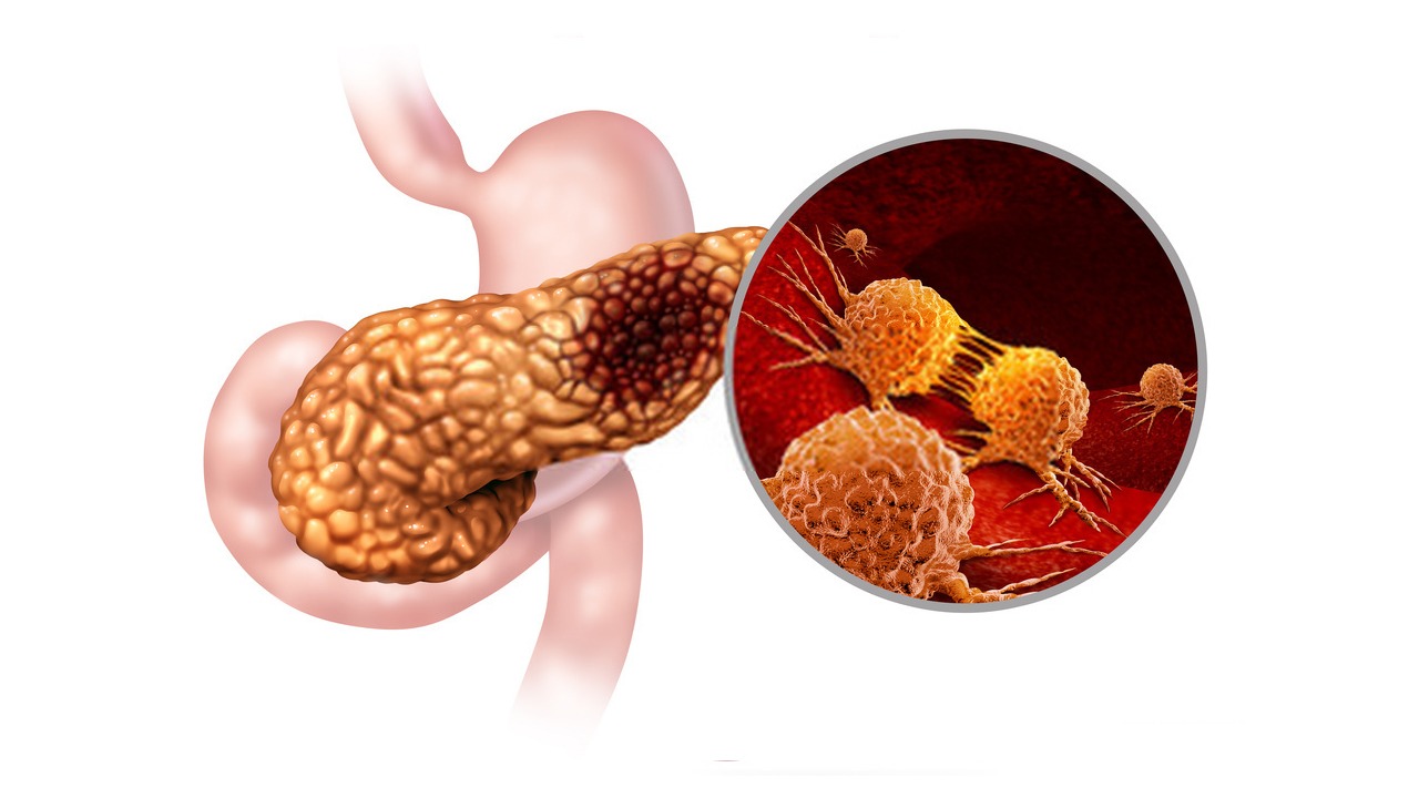 Global Pancreatic Cancer Industry