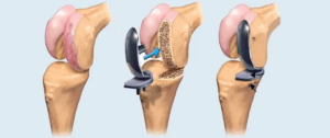 Knee Reconstruction Devices Market