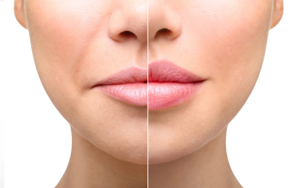 Lip Fillers Market 