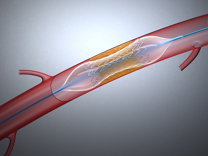 Neurovascular Stent Retrievers Market