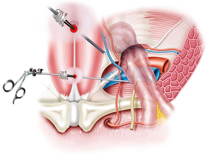 Postoperative Panniculus Retractor Market