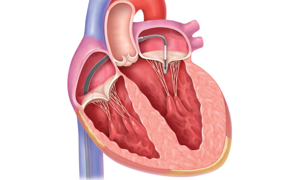 Transcatheter Mitral Valve Market