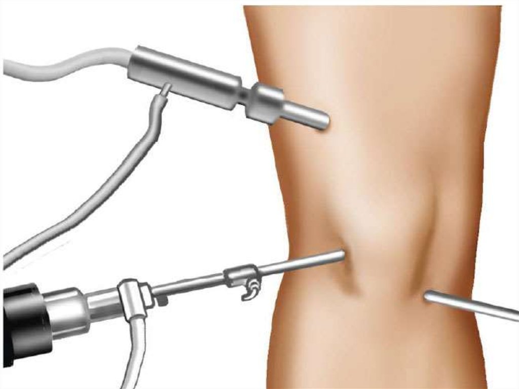 arthroscopy procedures and products market